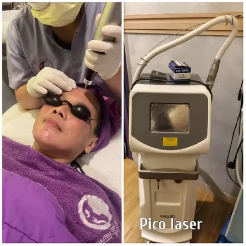 Facial Treatment with Pico Laser