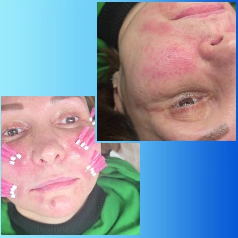 Beauty Treatment and Skin Reaction